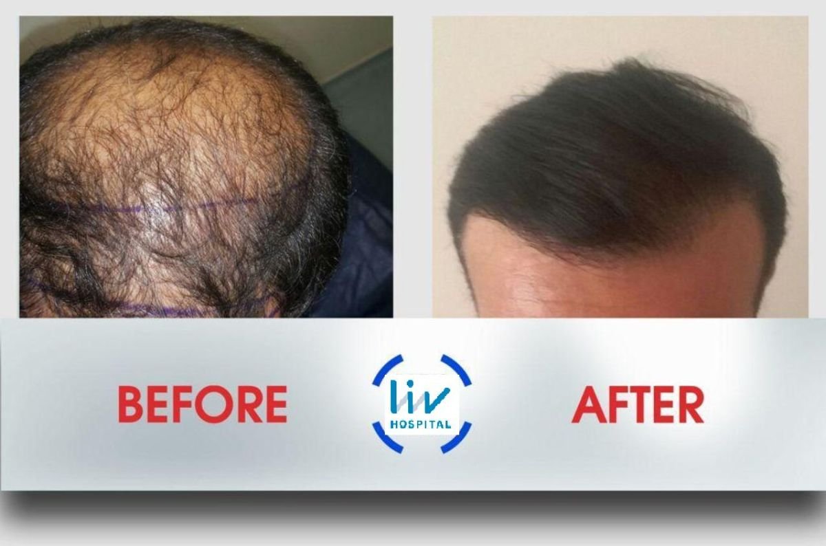 Before and after hair transplant results at Liv Hospital Ulus showing fuller hair restoration