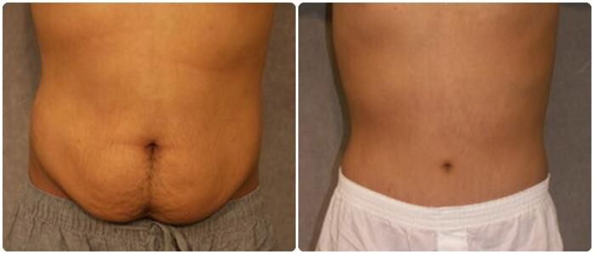 Before and after liposuction results at Asia Cosmetic Hospital, visible abdominal contour improvement