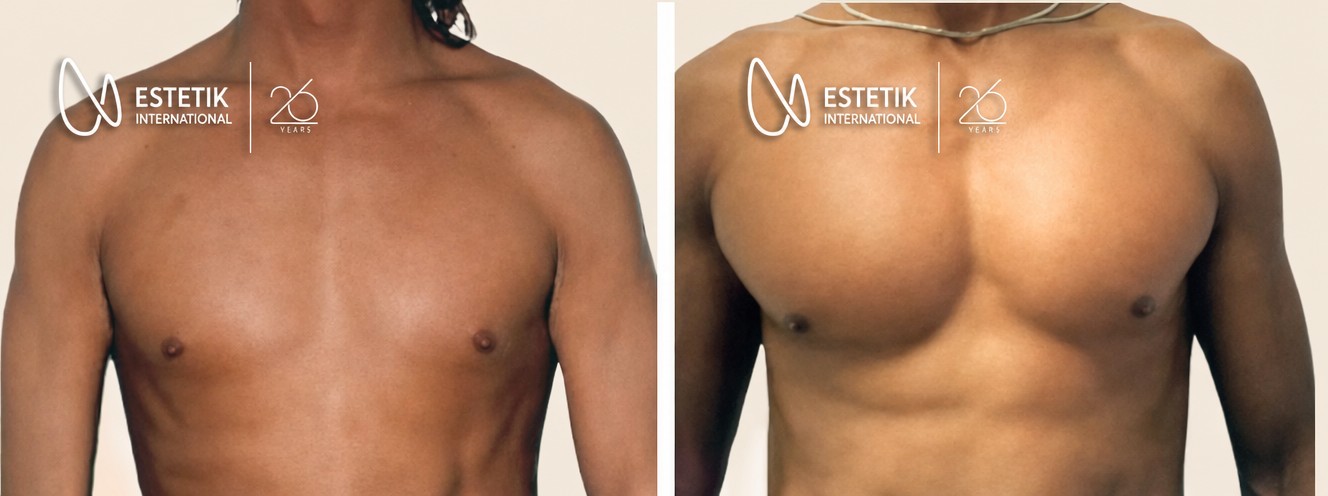 Résultat avant/après implants pectoraux à Estetik International Istanbul, torse sculpté