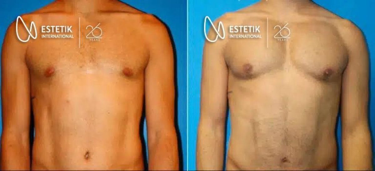 Before and after pectoral implants at Estetik International Istanbul, enhanced chest contour result