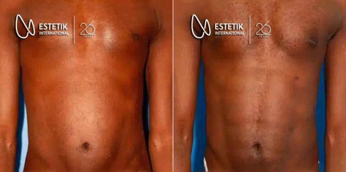 Resultados antes y después de implantes pectorales en Estetik International Istanbul