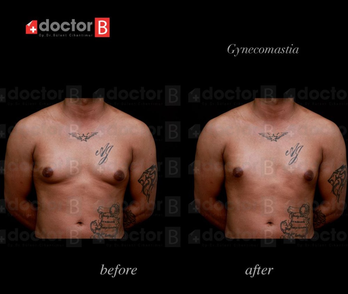 Before and after gynecomastia surgery results at Estetik International Istanbul, male chest contour