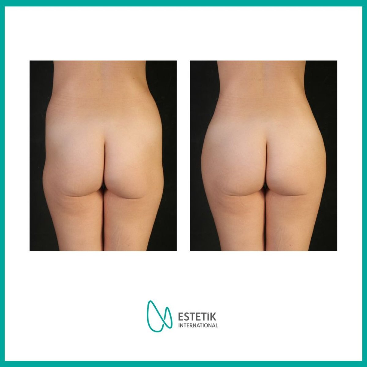 Before and after butt implants at Estetik International Istanbul – enhanced shape and volume result