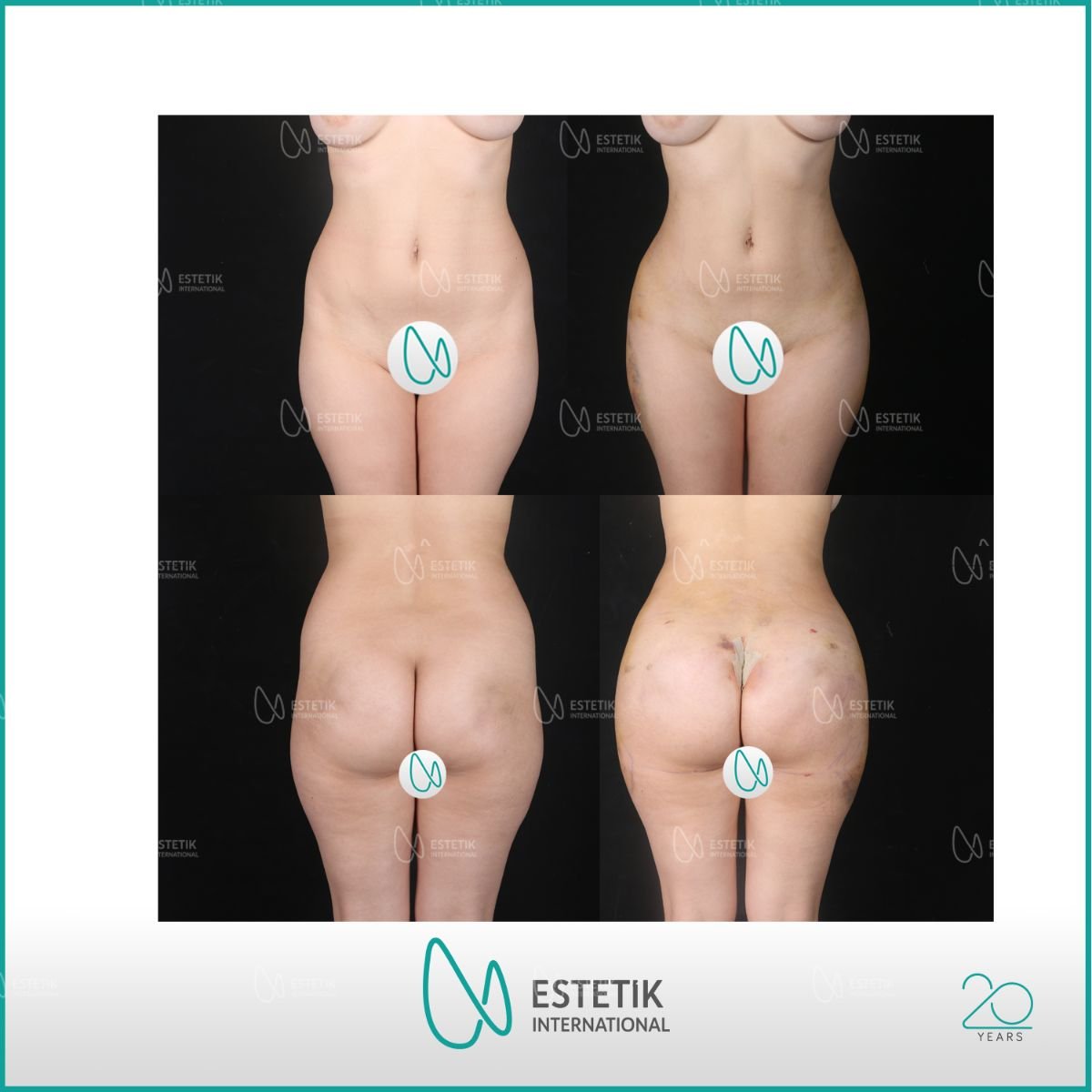 Antes y después de implantes de glúteos en Estetik International Istanbul, curvas mejoradas