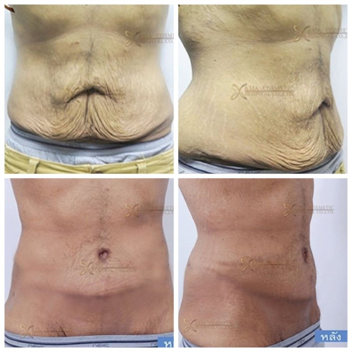 Before and after liposuction results at Asia Cosmetic Hospital, improved abdominal contour