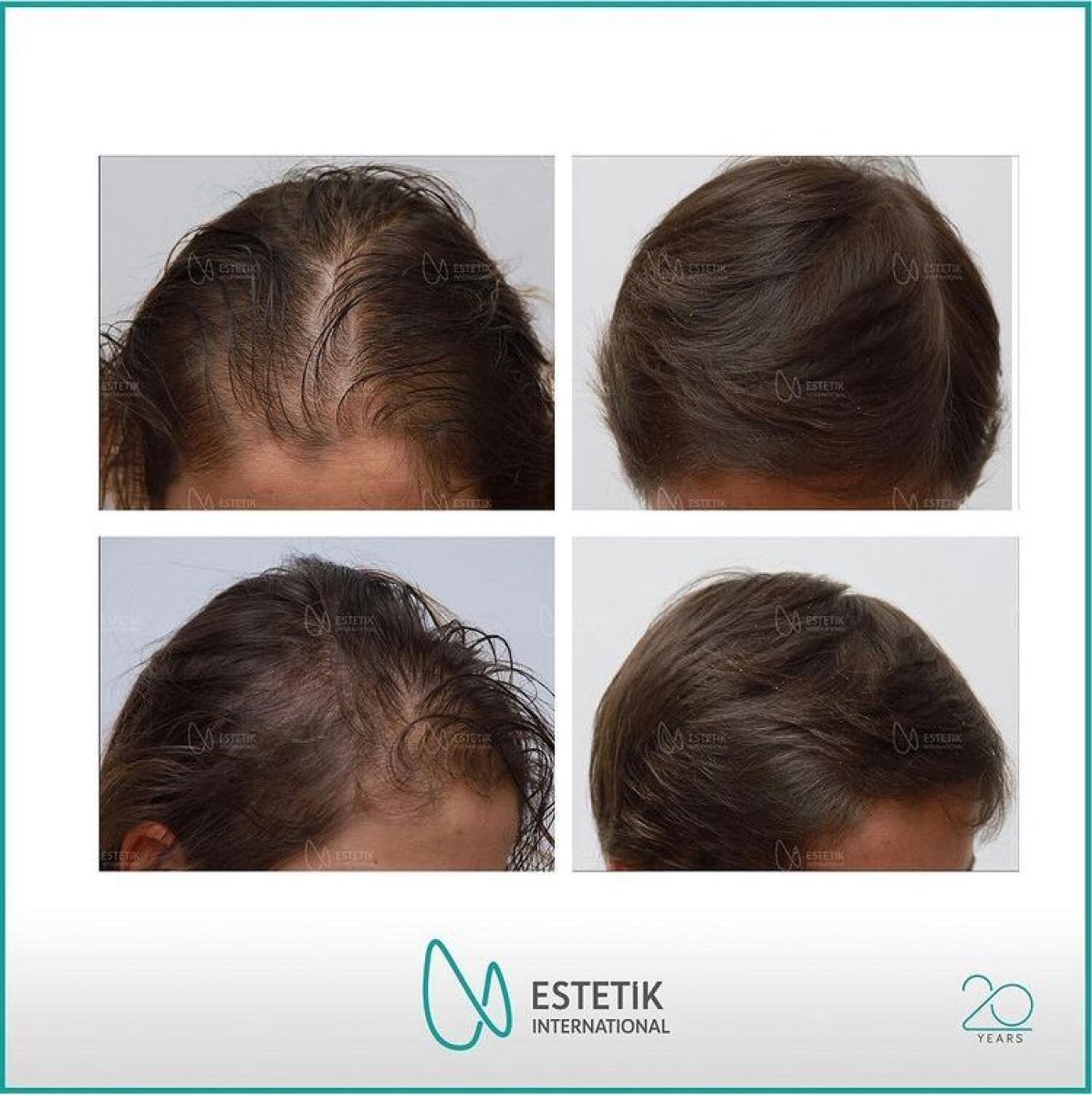 Résultats avant/après greffe de cheveux FUE chez Estetik International Istanbul, ligne capillaire plus dense