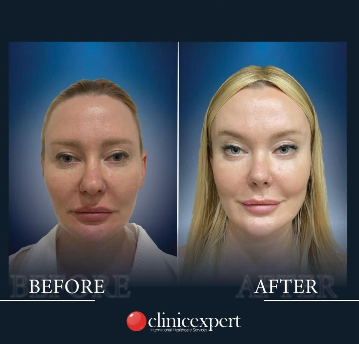 نتائج قبل وبعد Fox Eye Lift في CE International Hospital، تحسين محيط العين