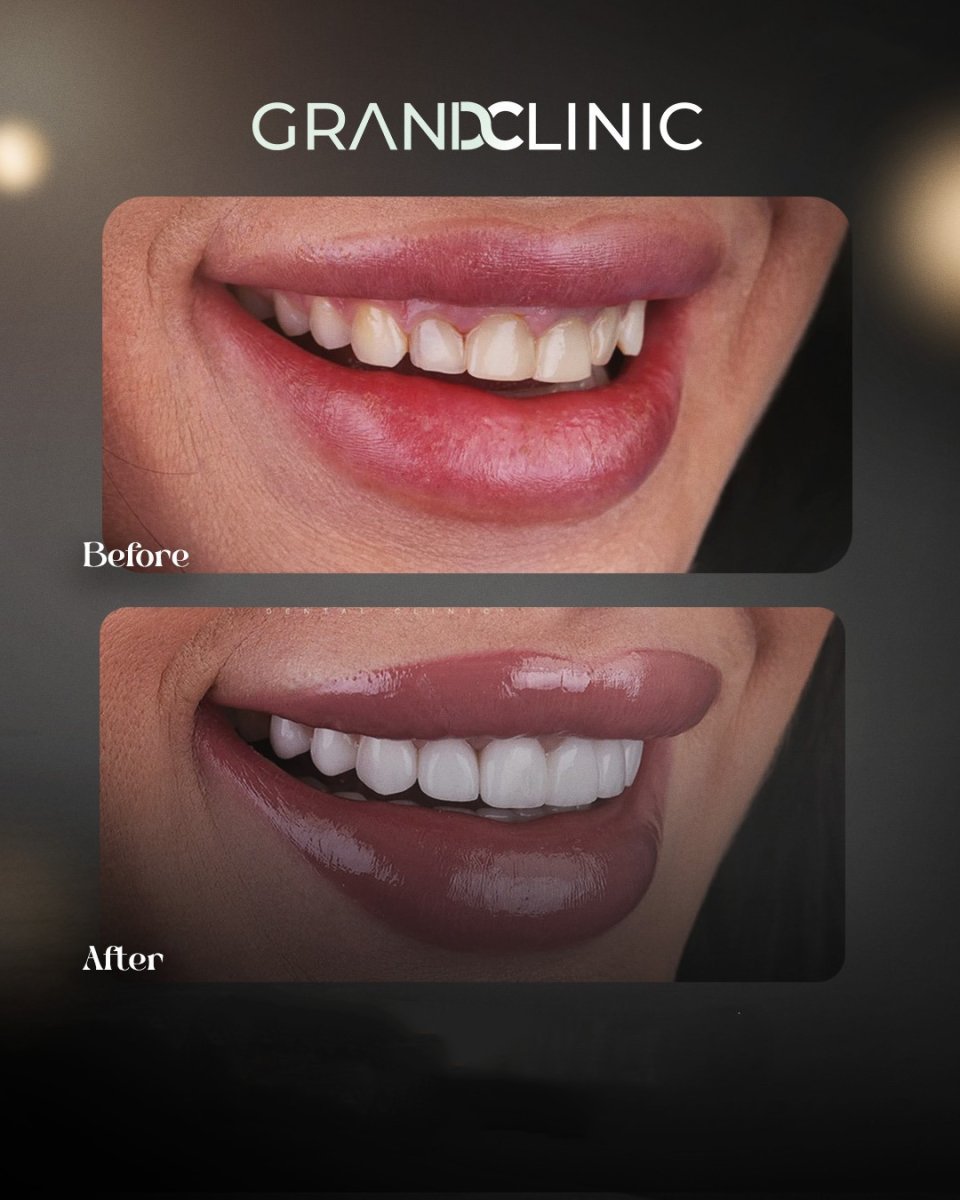 نتائج قبل وبعد ابتسامة هوليود في Grand Clinic – تحول الابتسامة بعد القشور الخزفية