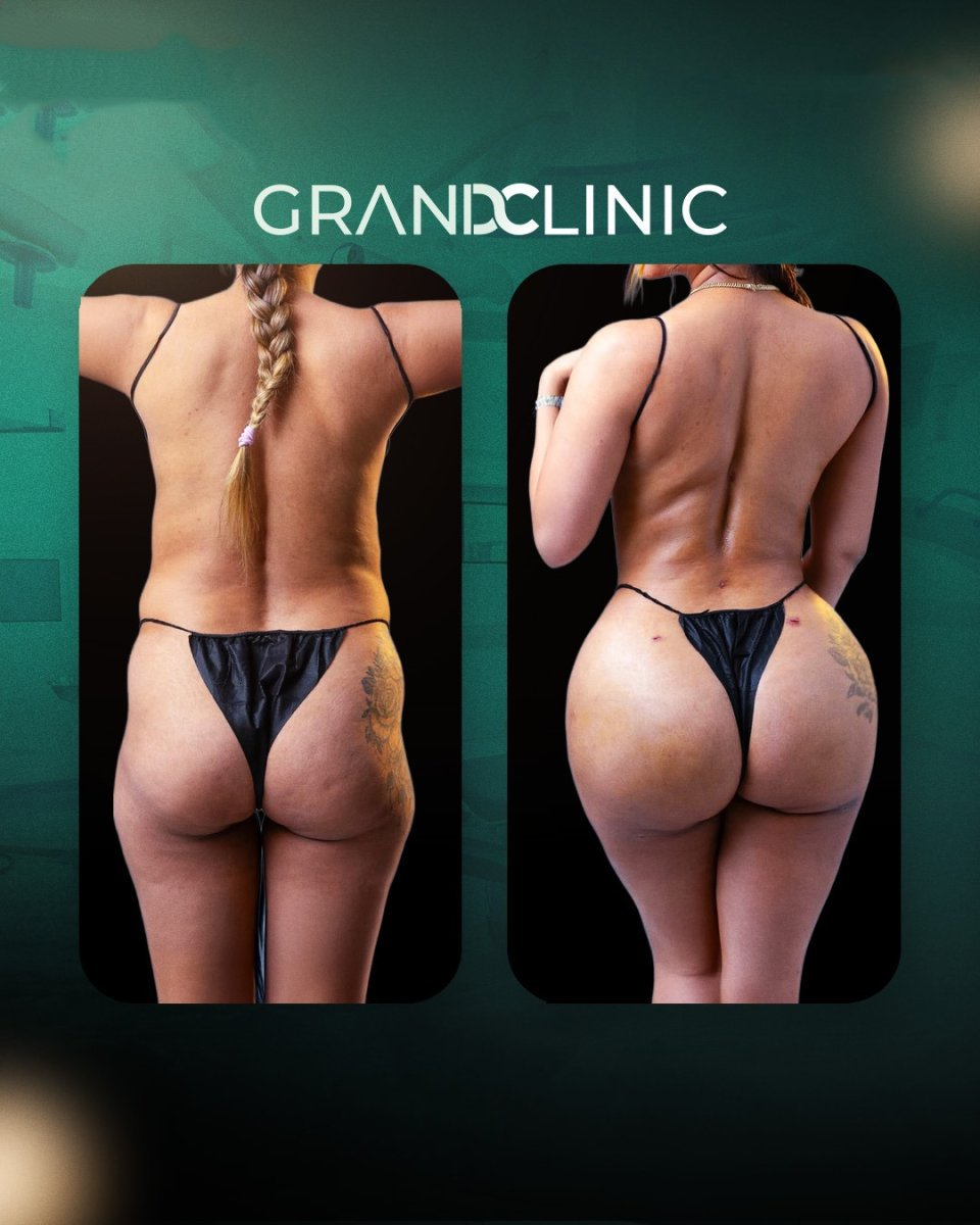Vorher-nachher-Ergebnis Brazilian Butt Lift bei Grand Clinic – verbesserte Gesäßform