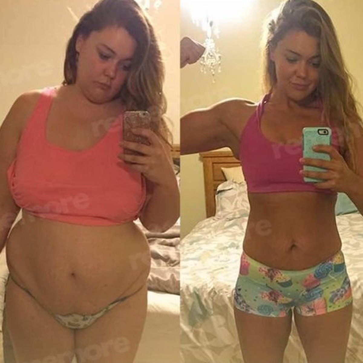 Antes y después de gastroplastia endoscópica en Memorial Ataşehir Hospital, resultado de pérdida de peso