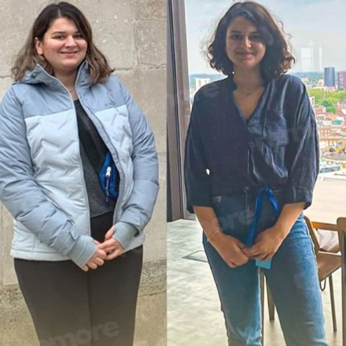 Resultados antes y después de gastroplastia endoscópica en Memorial Ataşehir Hospital