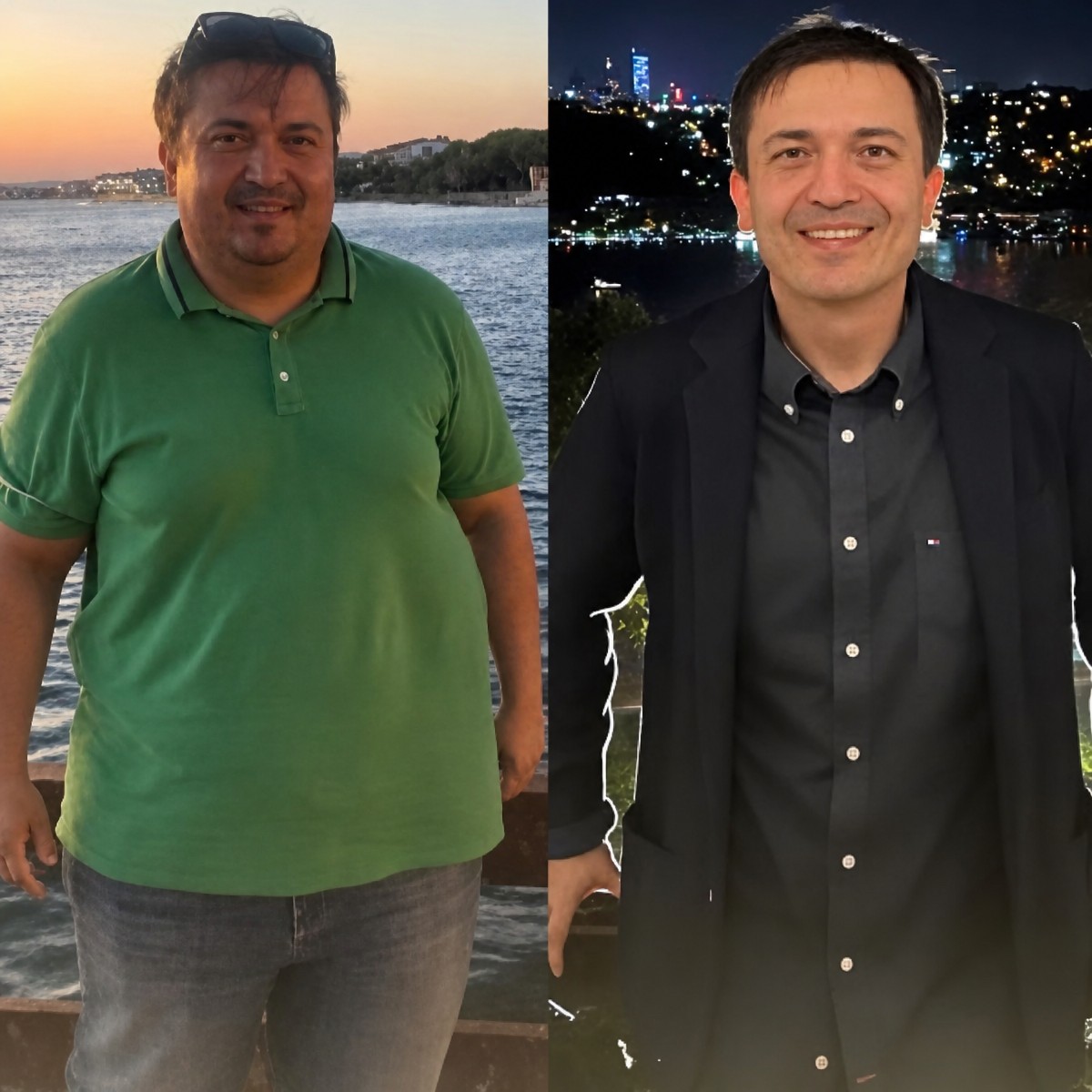 Antes y después de gastroplastia endoscópica en Memorial Ataşehir Hospital, resultado de pérdida de peso