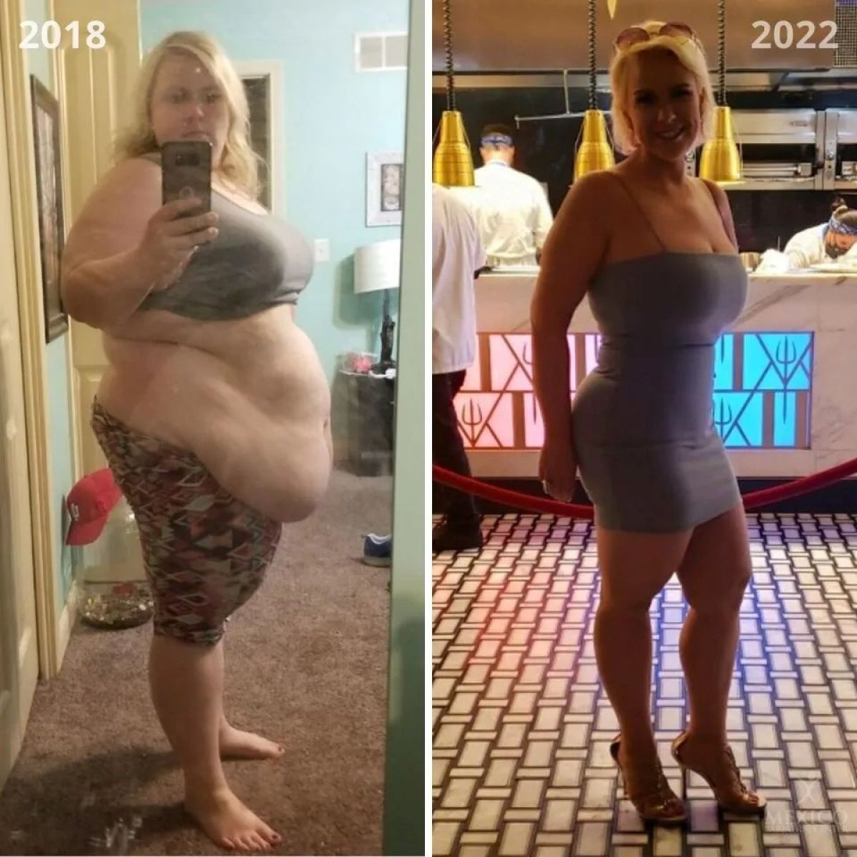 Before and after gastric sleeve surgery at Wansiri Hospital – significant weight loss result