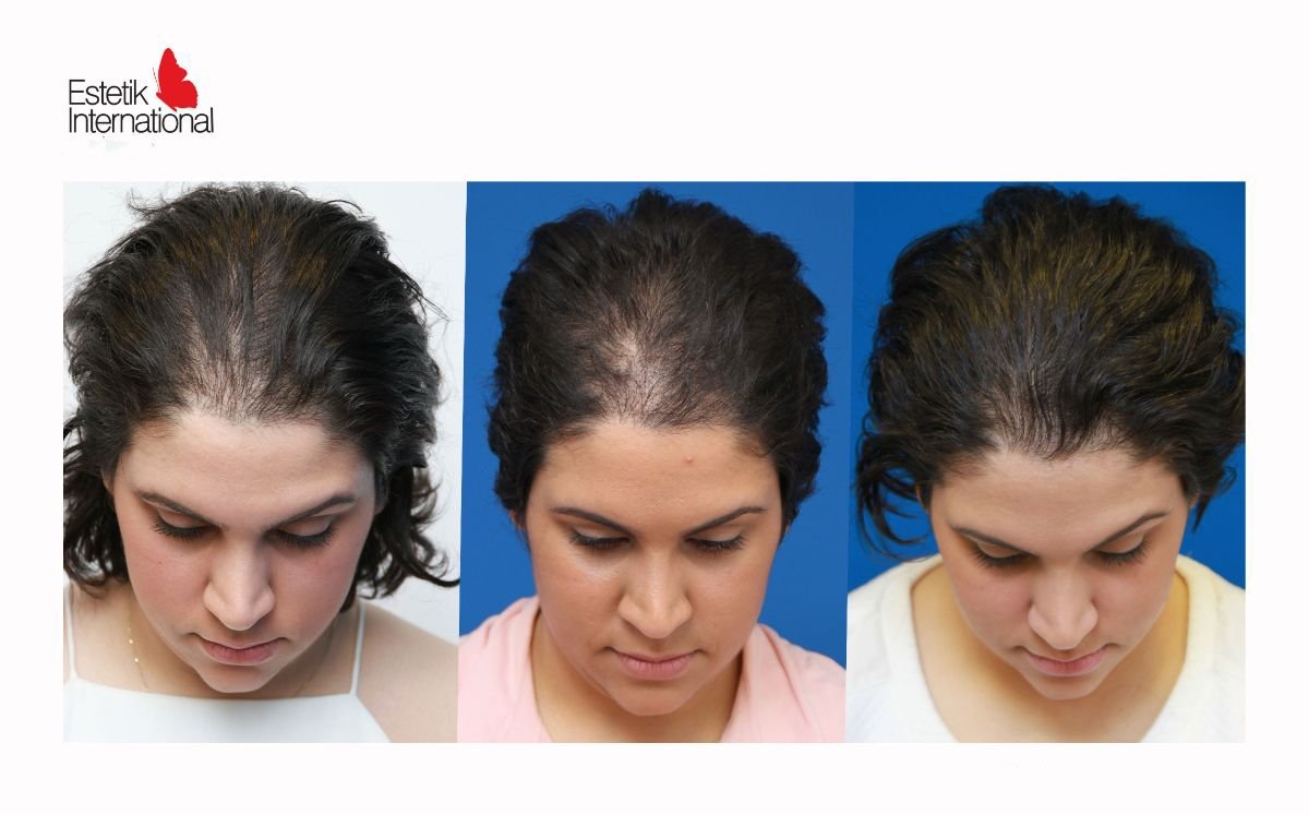 نتائج زراعة الشعر FUE قبل وبعد في عيادة Estetik International Istanbul، كثافة شعر محسنة