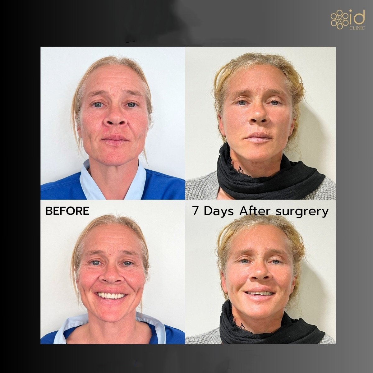 Before and after blepharoplasty results at ID Clinic Bangkok, eyelid correction after 7 days