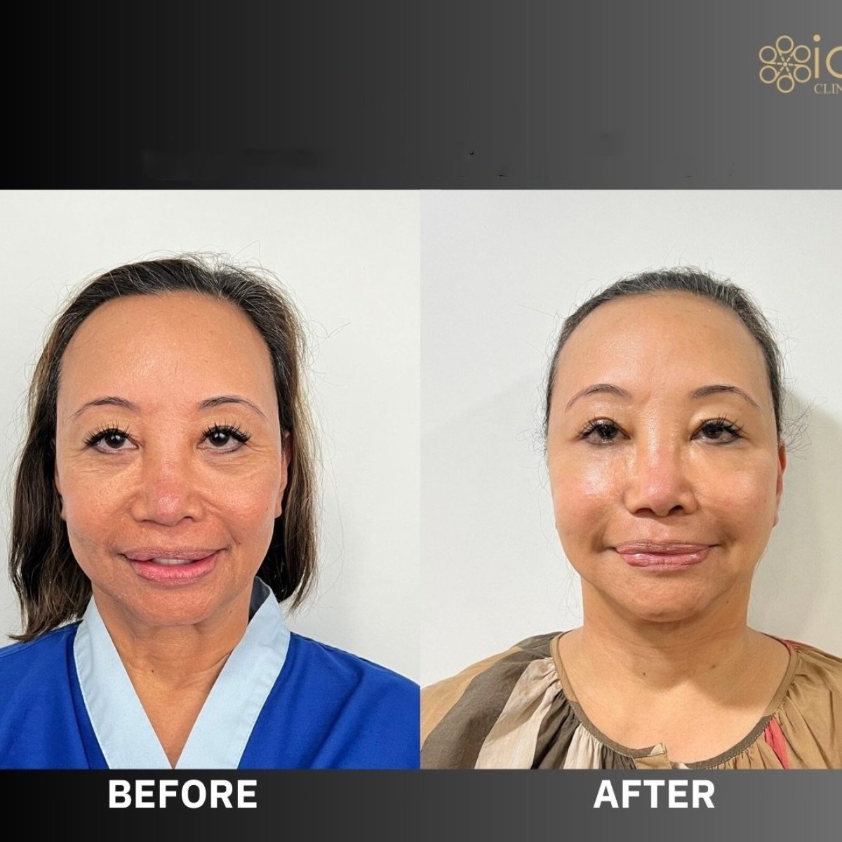 Before and after blepharoplasty results at ID Clinic Bangkok, eyelid correction improvement