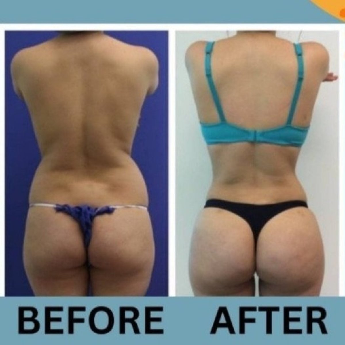 Before and after Brazilian Butt Lift results at ID Clinic Bangkok – enhanced buttock contour