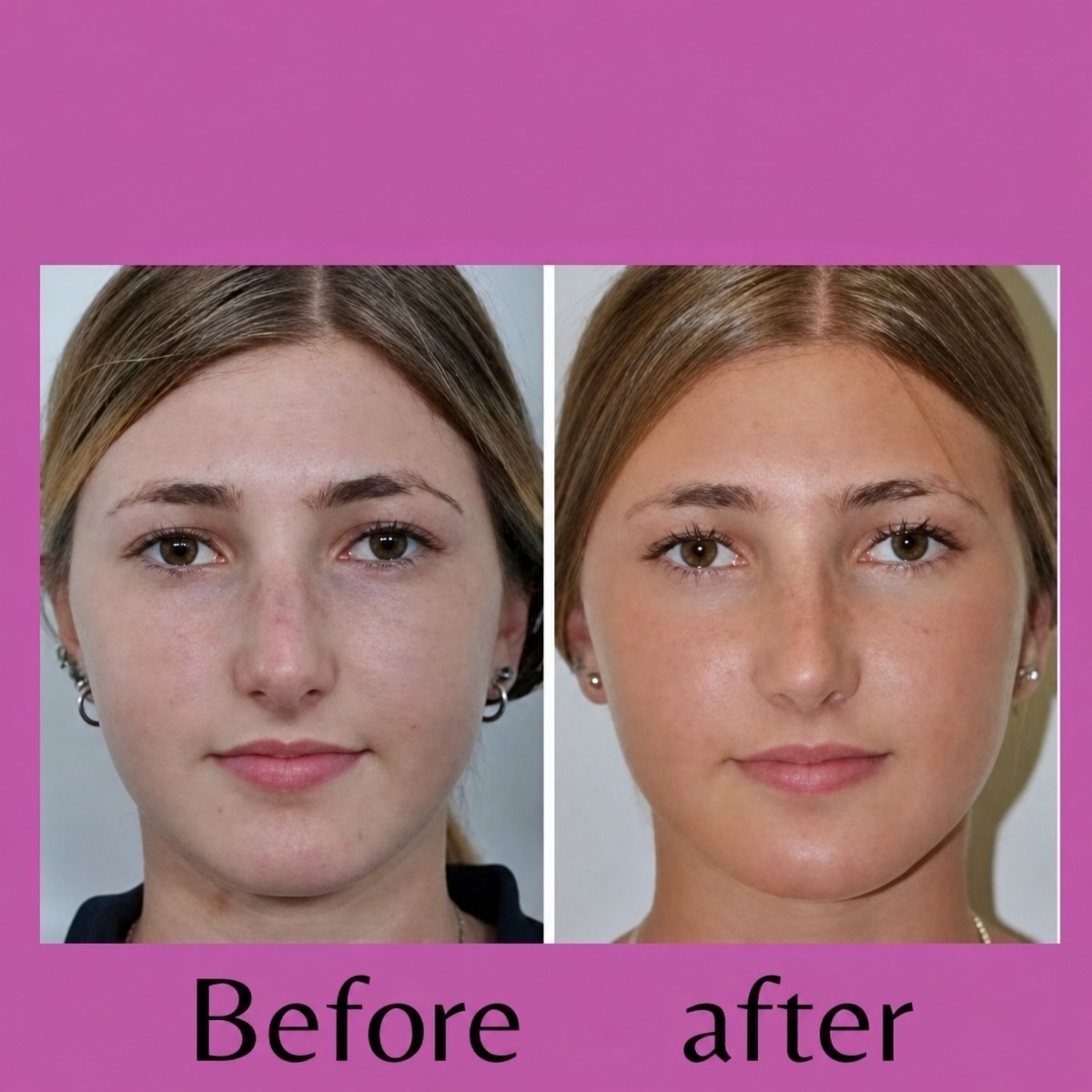 Before and after ultrasonic rhinoplasty result at ID Clinic Bangkok, refined nose shape