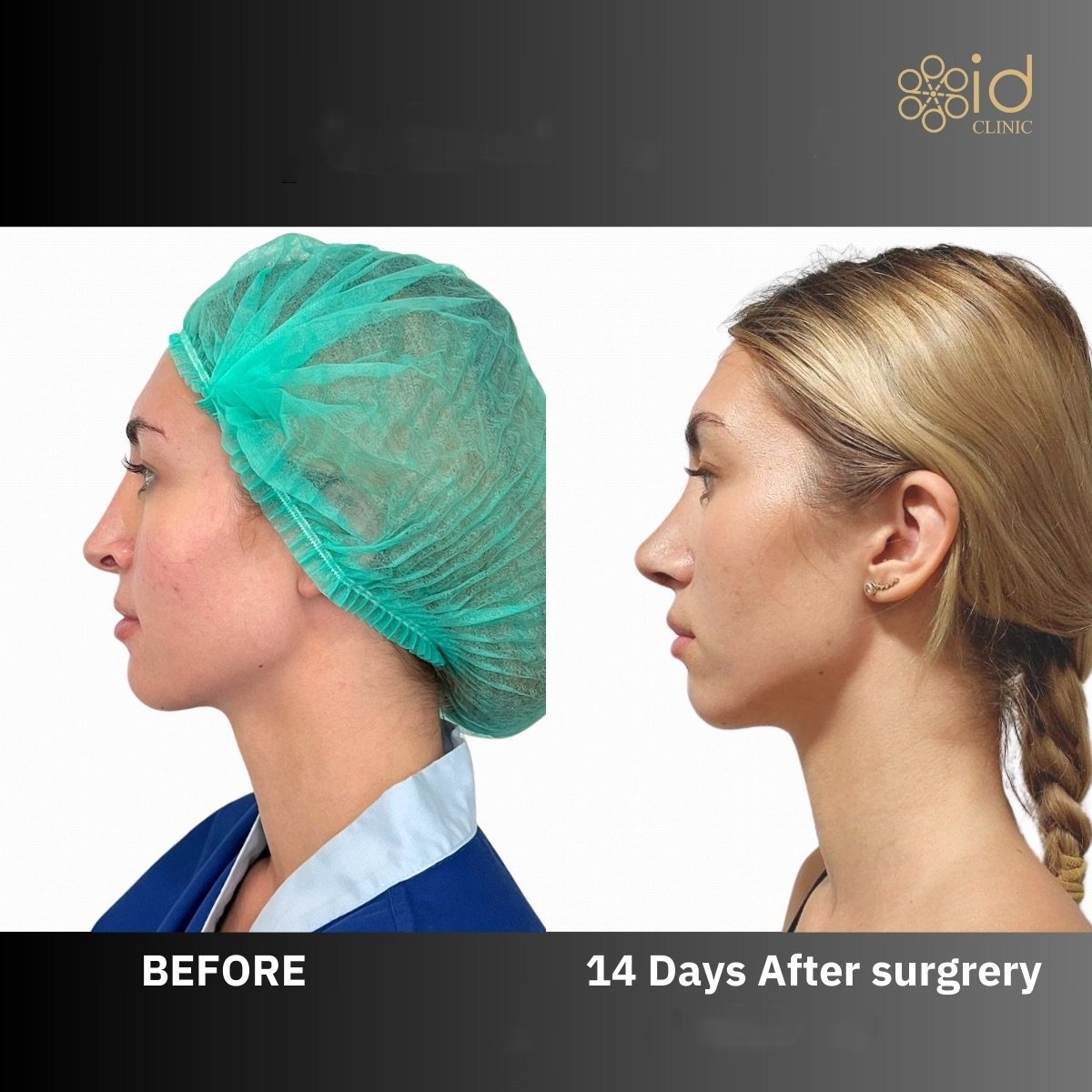 Результат до и после ультразвуковой ринопластики в ID Clinic Bangkok, 14 дней после