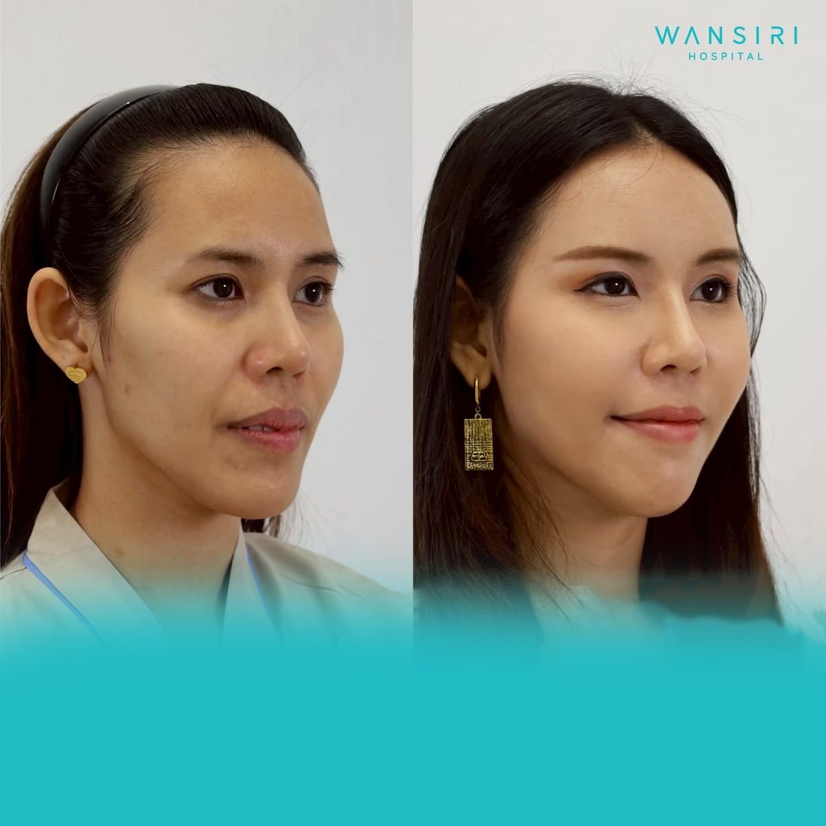 Antes y después de transferencia de grasa facial en Wansiri Hospital, mayor volumen facial