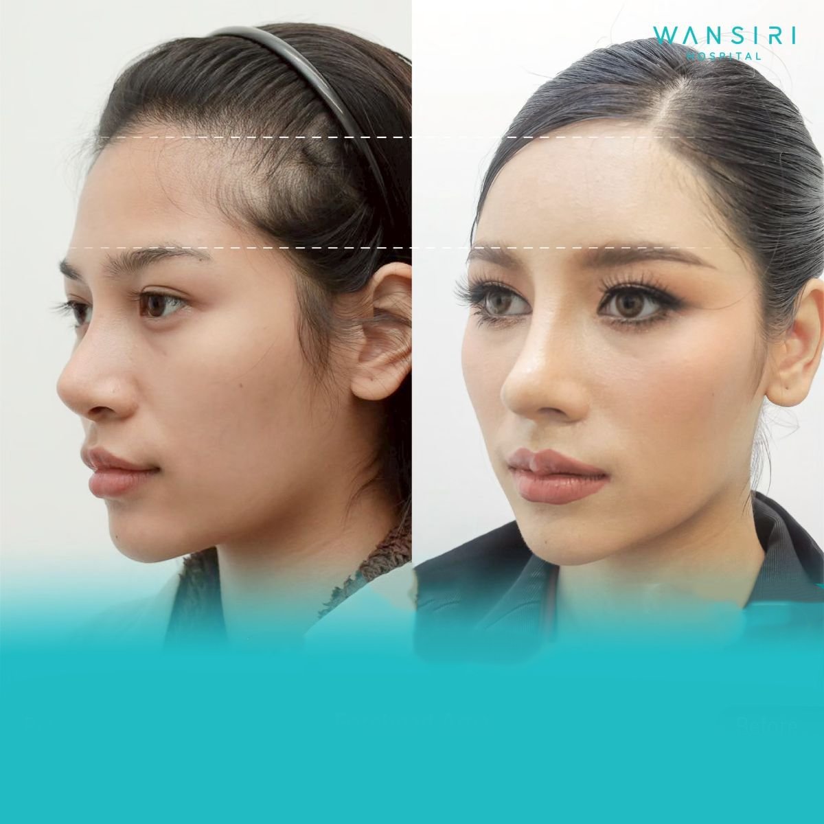 Antes y después de transferencia de grasa facial en Wansiri Hospital, contorno mejorado