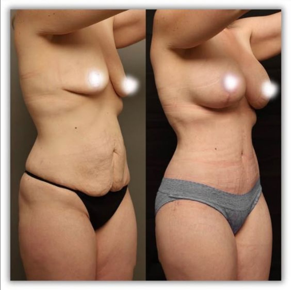 Before and after breast augmentation and tummy tuck results at Medical Park Antalya Hospital Complex