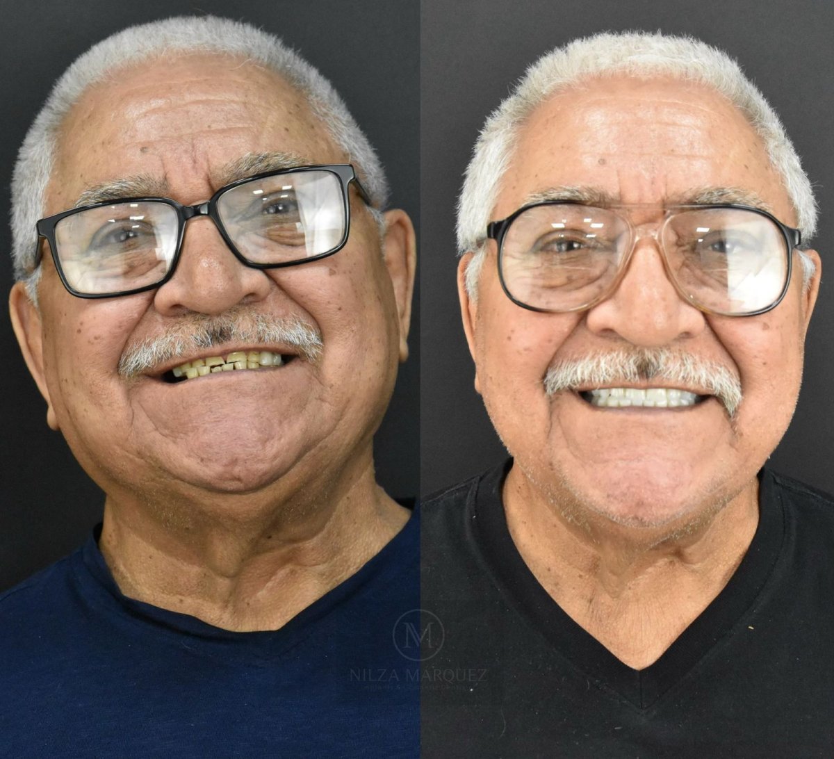 Before and after zirconia crown installation results at DDS Nilza Márquez Dental Practice