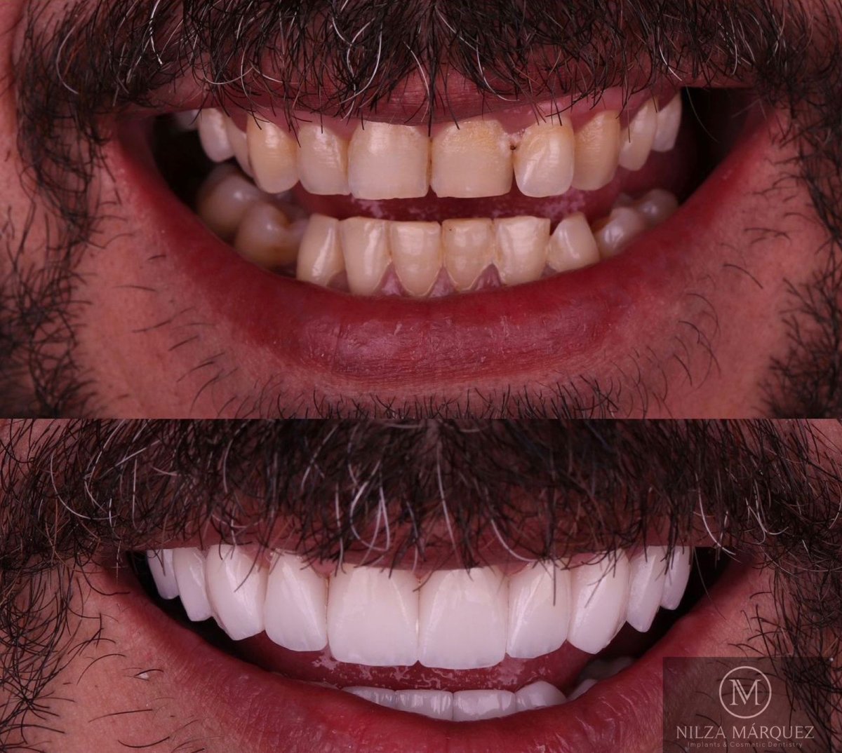Результат до и после виниров в DDS Nilza Márquez Dental Practice, преображение улыбки