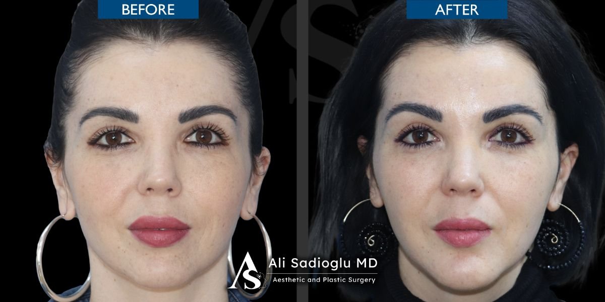Résultats avant/après implant du menton à la clinique Dr. Safa Manav, contour amélioré