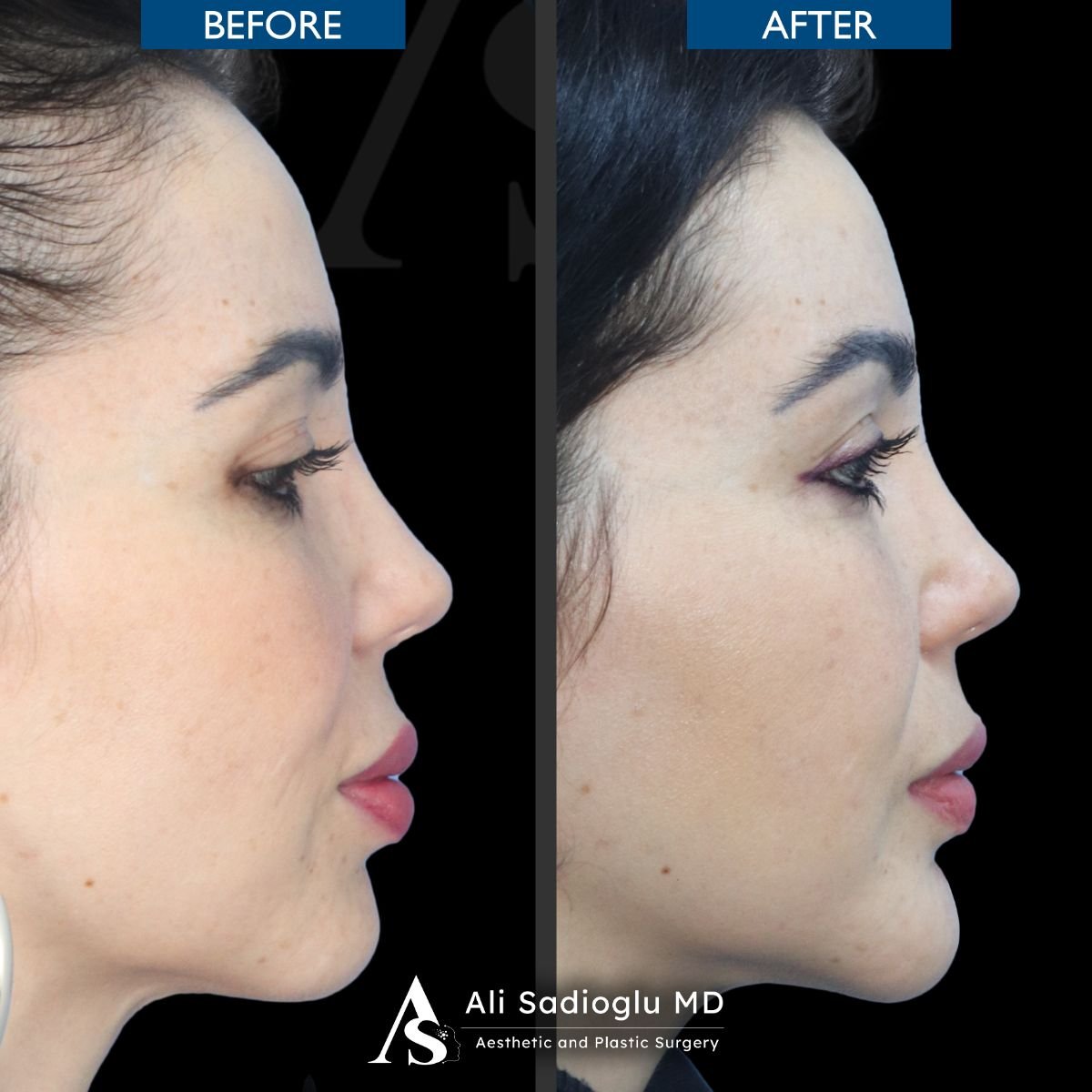 Efekty przed i po implantacji brody w Dr. Safa Manav Clinic, poprawiony profil