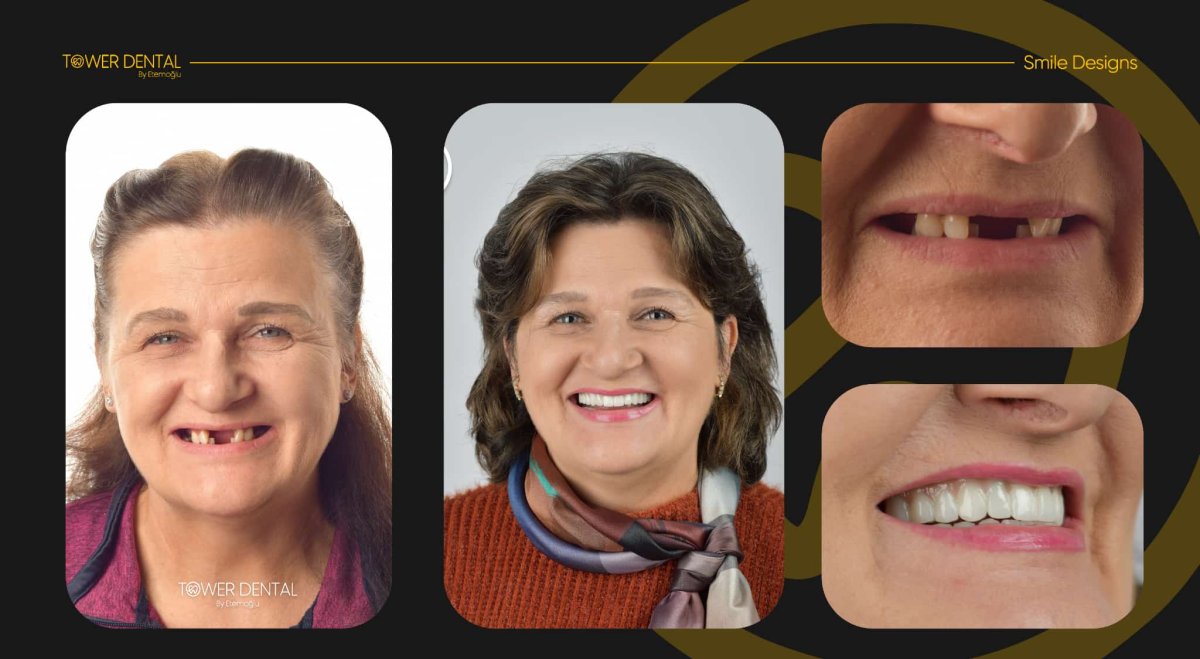 Antes y después de implantes dentales All-on-6 en Tower Dental Clinic, resultado de sonrisa