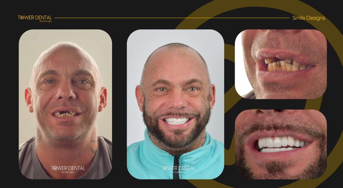 Resultados antes y después de implantes All-on-6 en Tower Dental Clinic, restauración de sonrisa