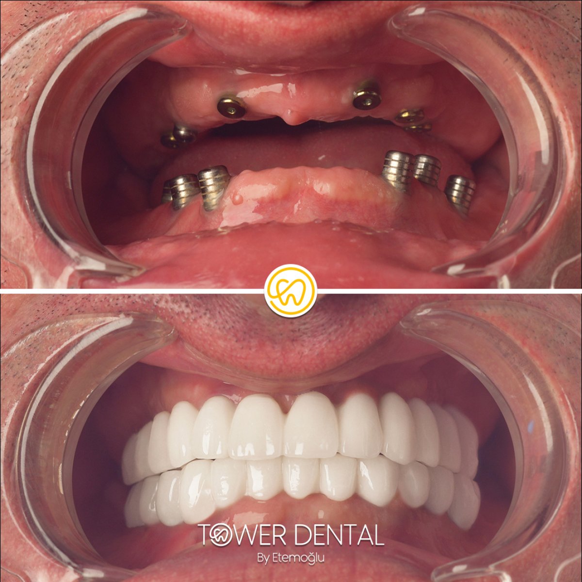Before and after All-on-6 dental implants result at Tower Dental Clinic, full smile restoration