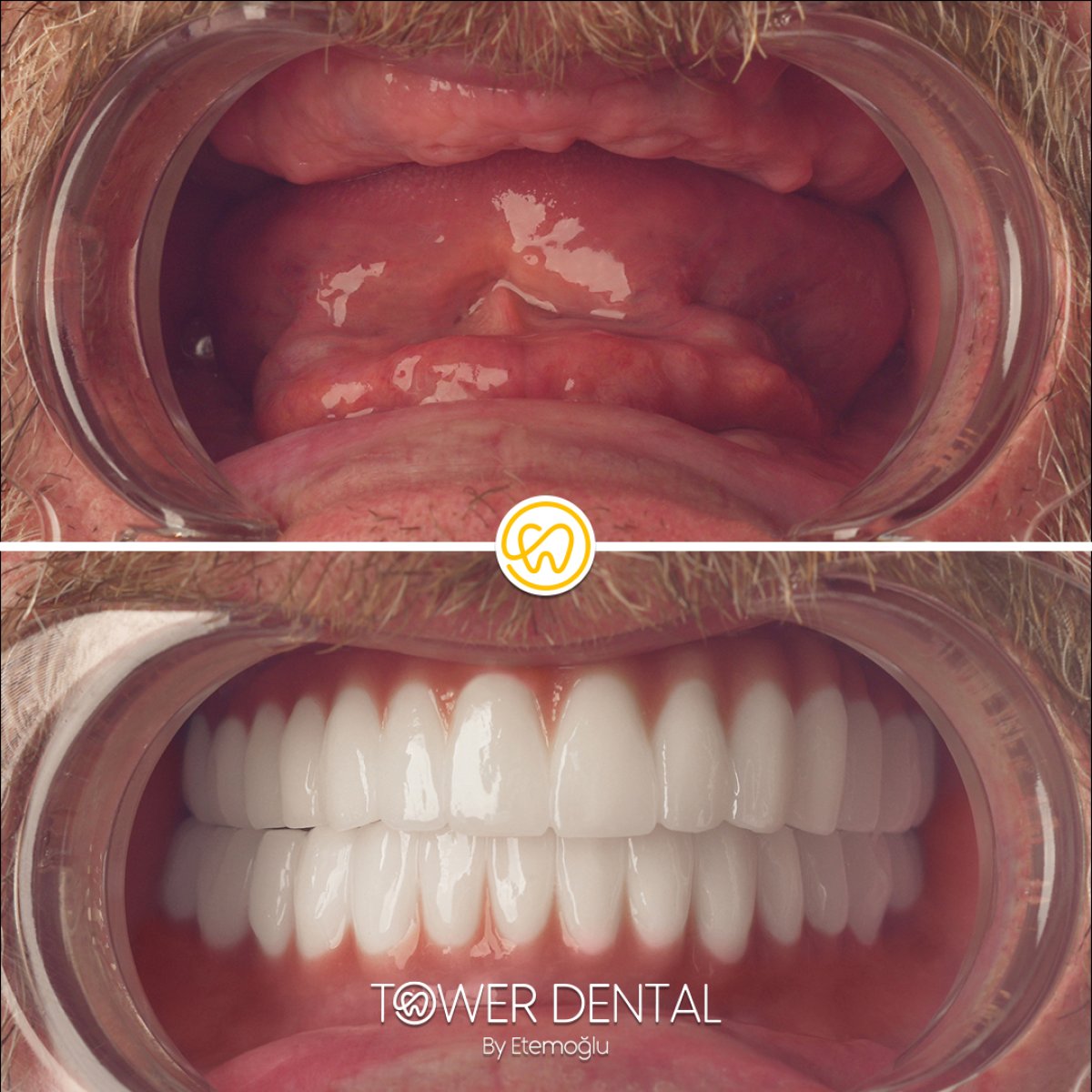 Результат до и после установки All-on-6 имплантов в Tower Dental Clinic, восстановление улыбки