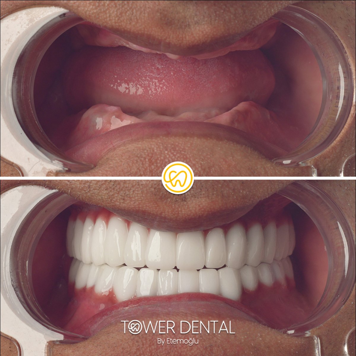 Resultados antes y después de implantes All-on-6 en Tower Dental Clinic, restauración total de sonrisa
