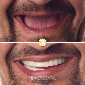 All-on-6 Implants with Accommodation. - photo 6
