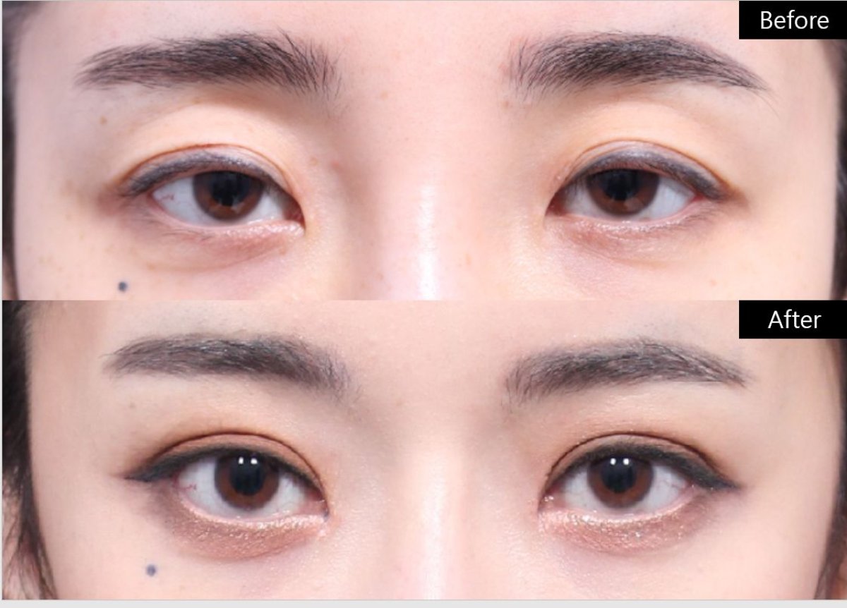 نتائج قبل وبعد جراحة الجفن المتدلي في VG Plastic Surgery، مظهر عين محسّن