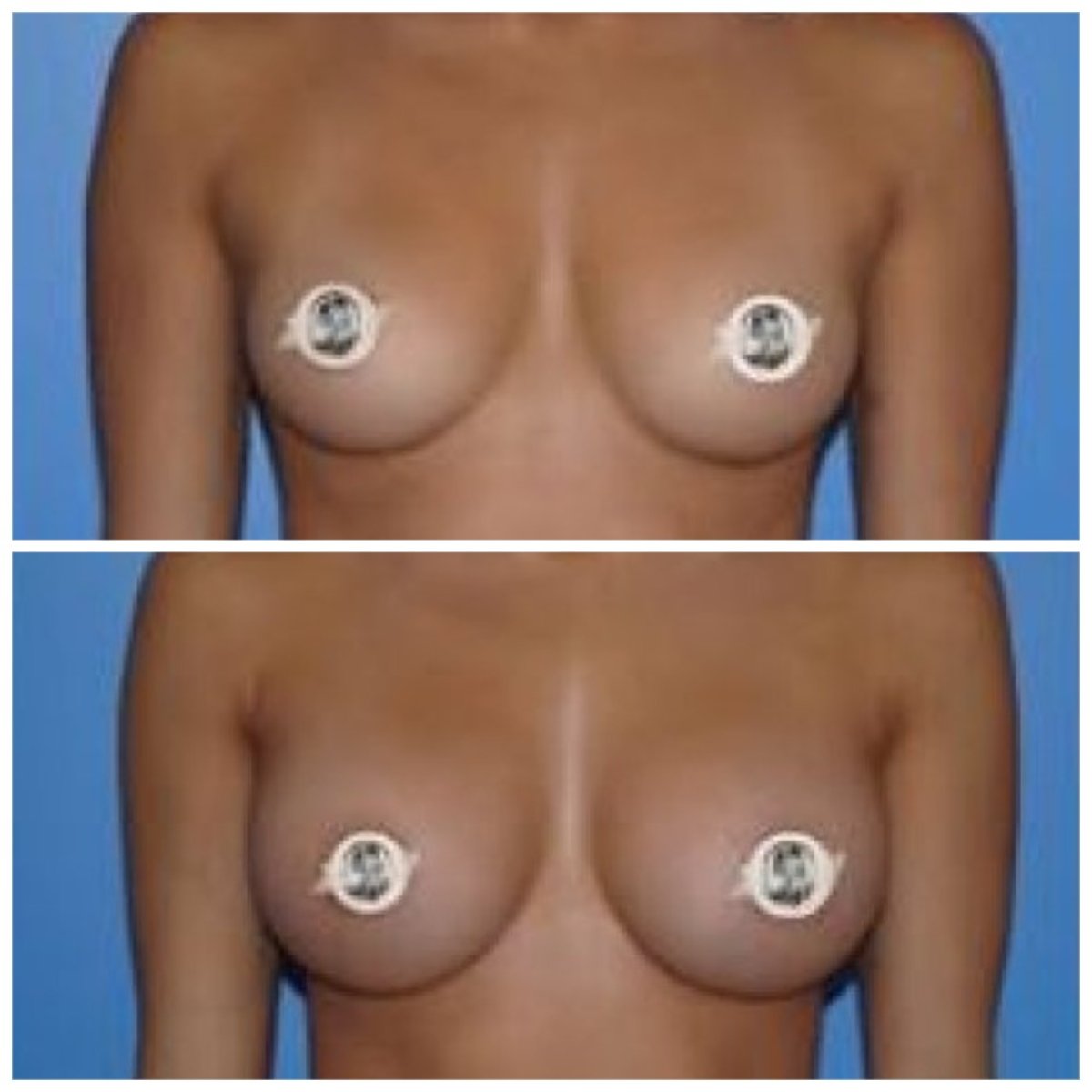 Before and after breast augmentation results at Medical Park Antalya Hospital Complex