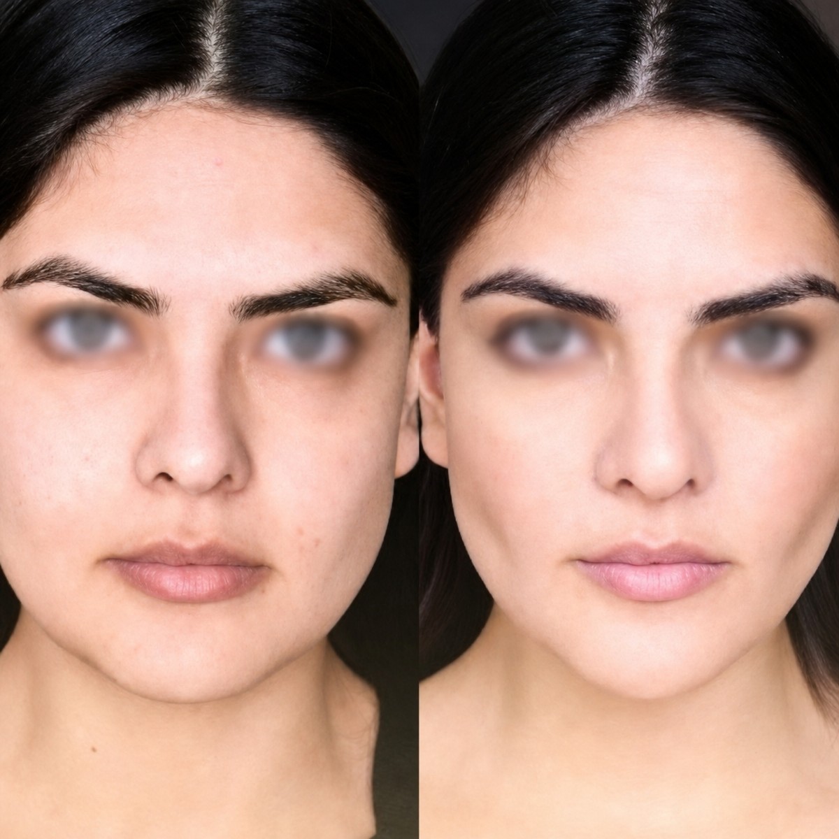 Before and after buccal fat extraction at Memorial Bahçelievler Hospital, slimmer cheeks result