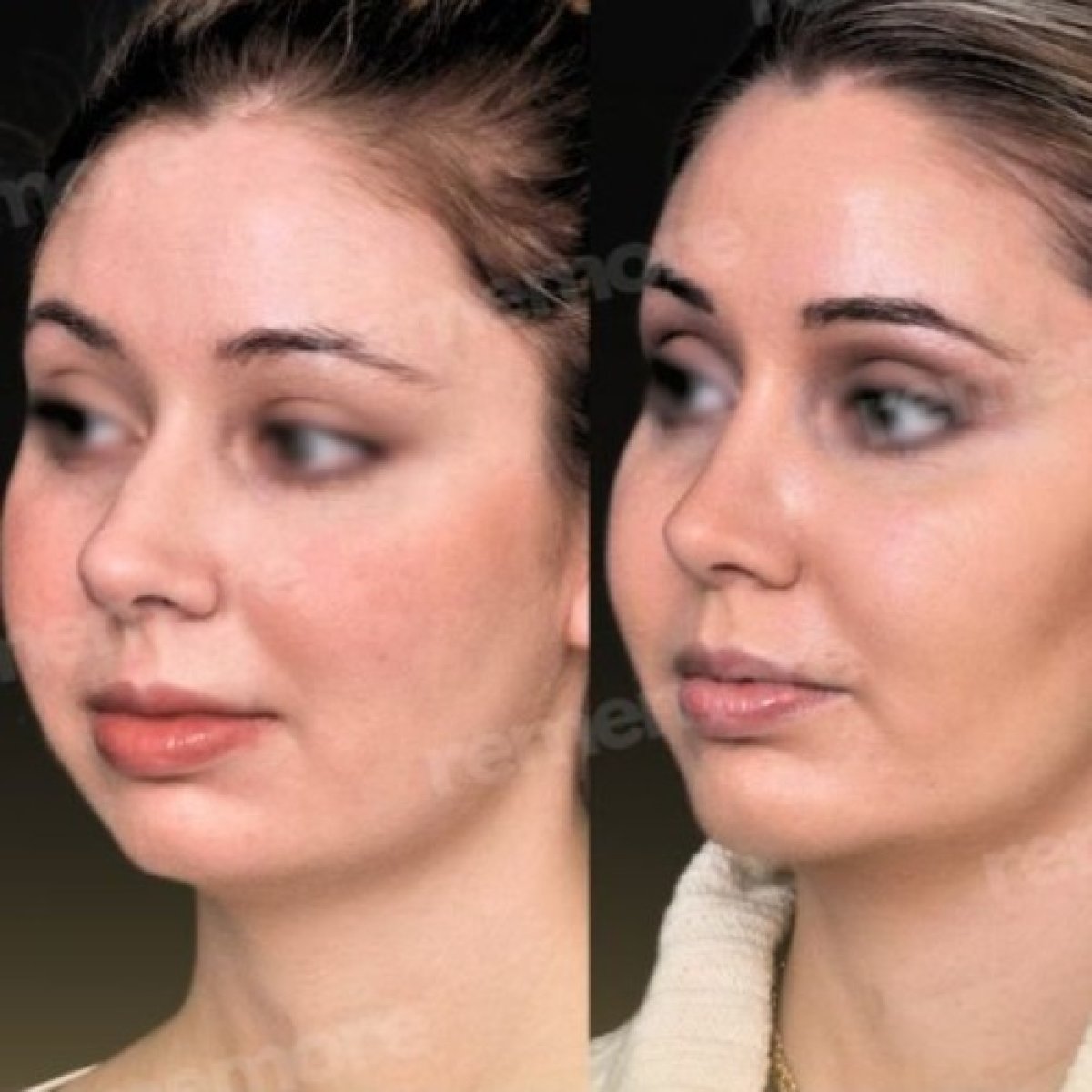 Before and after buccal fat extraction result at Memorial Bahçelievler Hospital, facial contouring