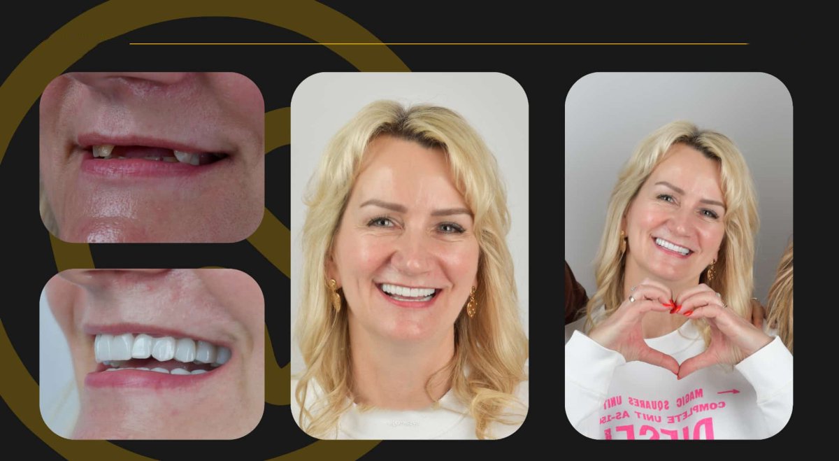 All-on-6 dental implants before and after results at Tower Dental Clinic, restored smile