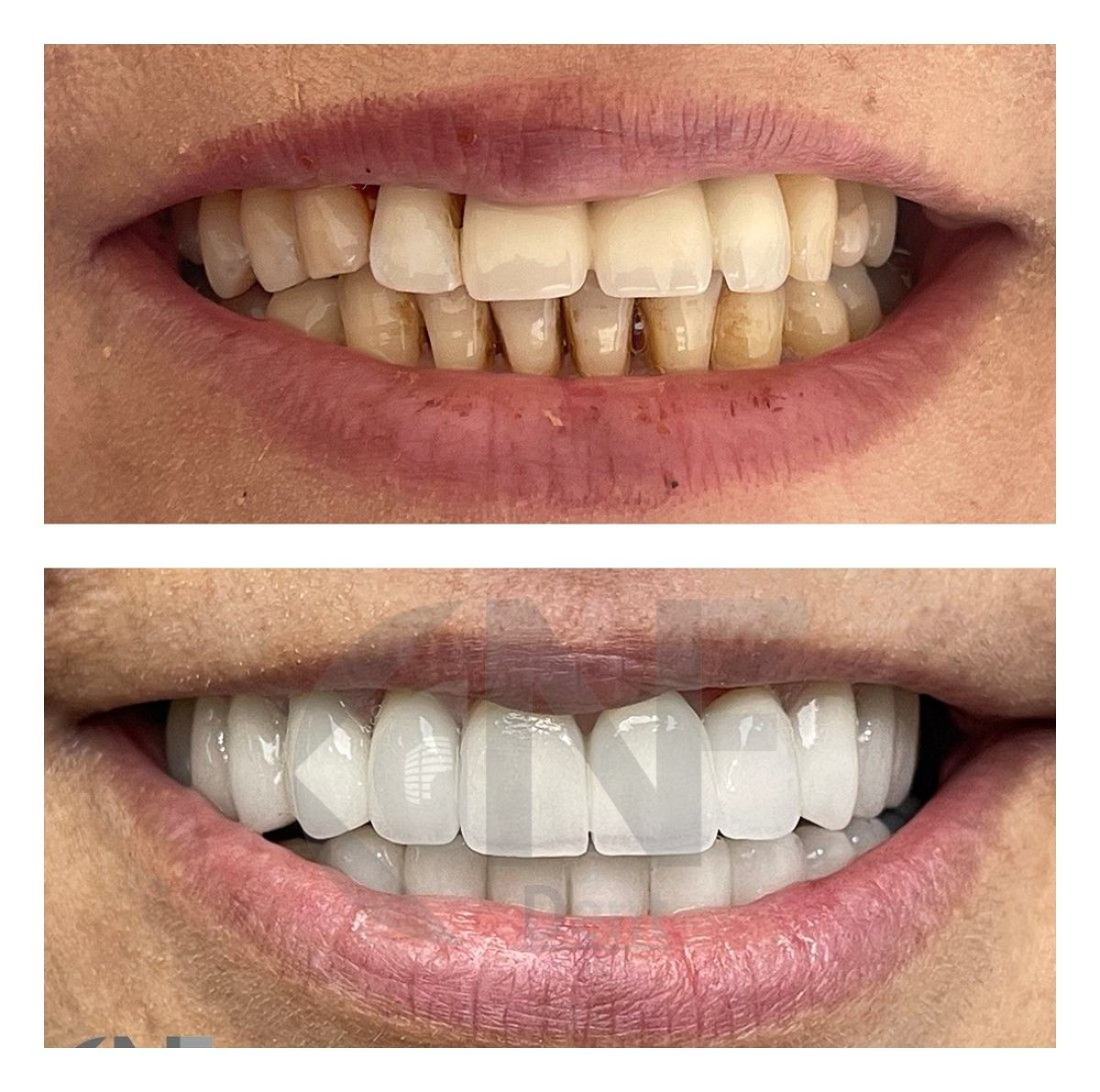 Before and after dental crown replacement results at Nifa Dent International, improved smile
