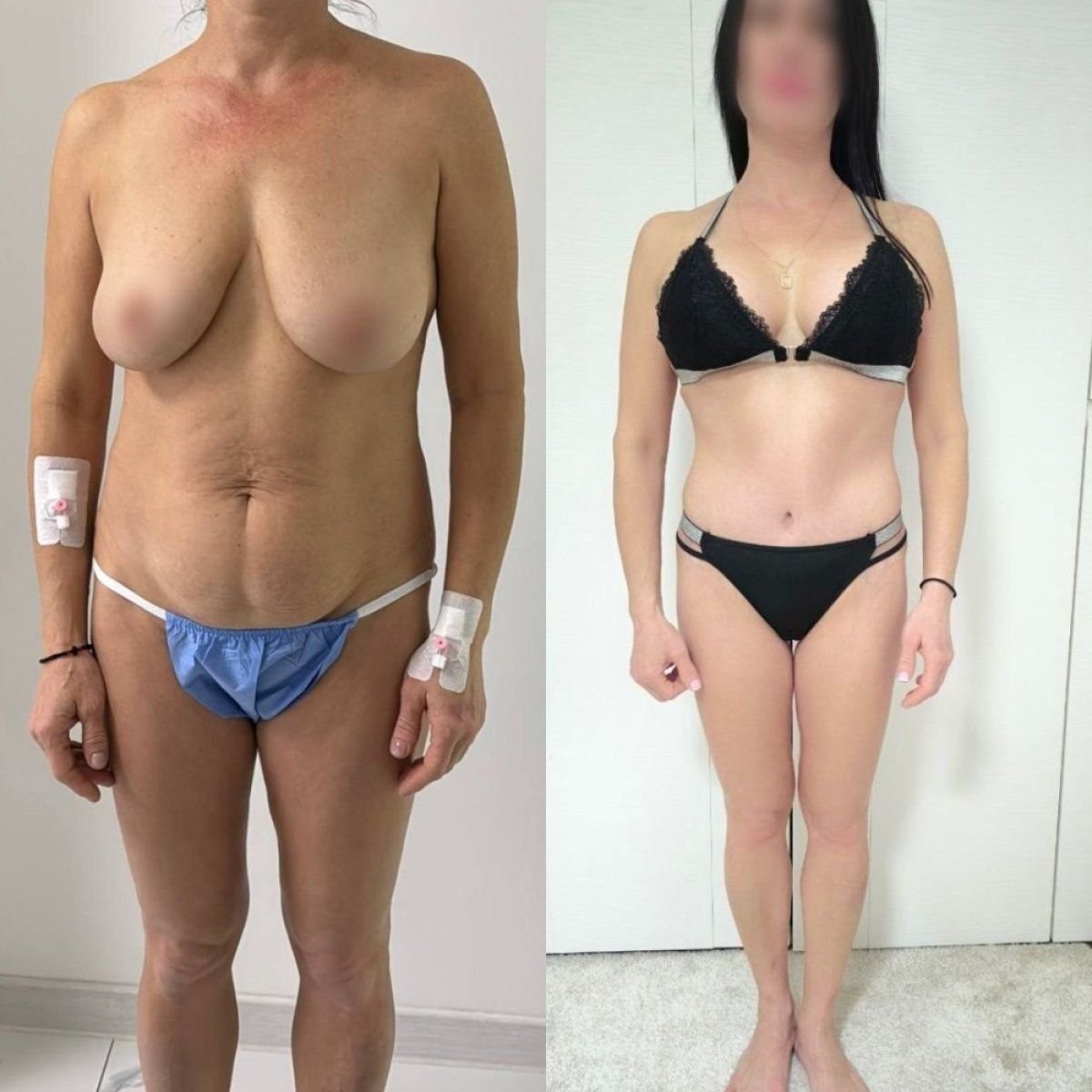 Before and after breast lift results at Dmytrii Homola Clinic, improved breast and body contour