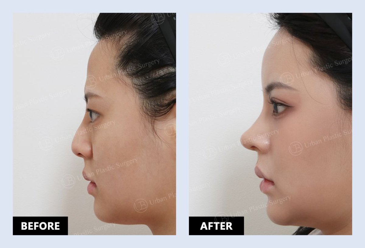 Before and after alarplasty results at URBAN Plastic Surgery, nose reshaping for refined look