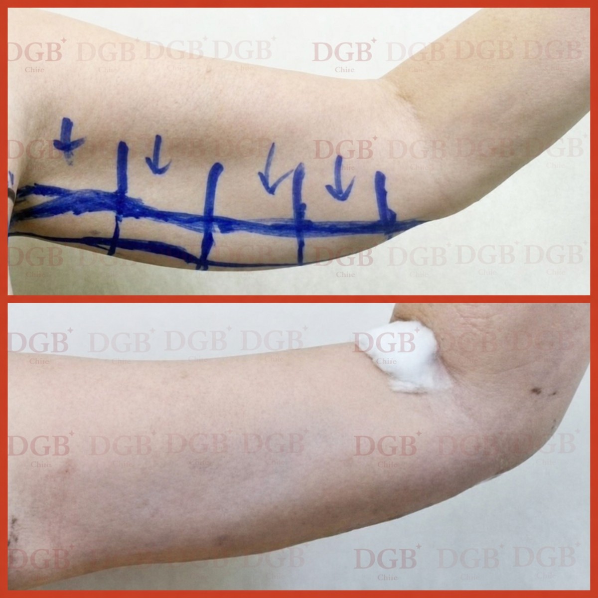 Before and after arm lift (brachioplasty) results at DGB Clinic, improved arm contour