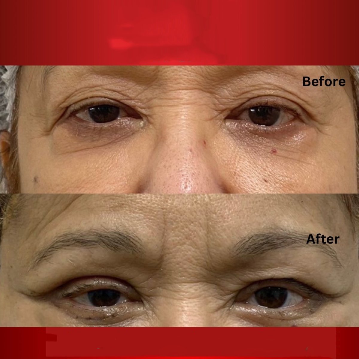 Résultats avant/après blépharoplastie supérieure et inférieure à DGB Clinic, yeux rajeunis