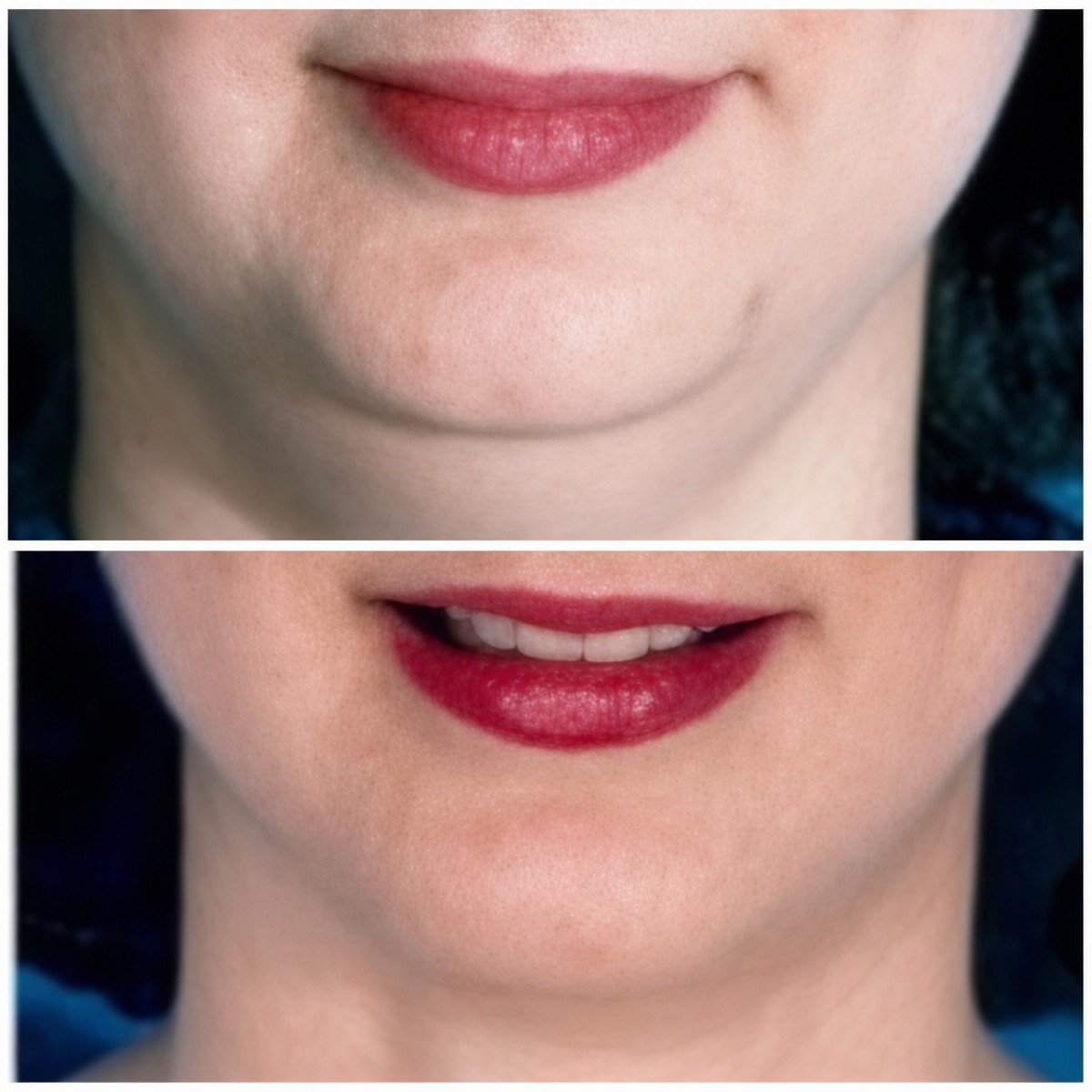 Before and after jaw shaping at ID Clinic Bangkok, improved chin contour and jawline result