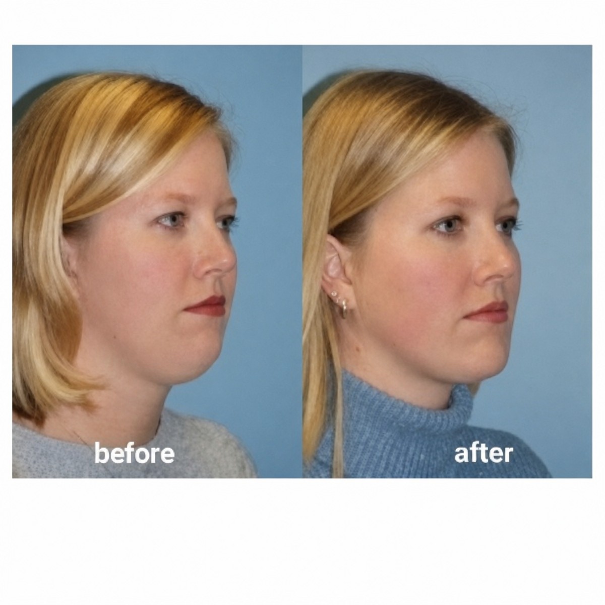 Before and after jaw shaping results at ID Clinic Bangkok – improved chin and jawline contour
