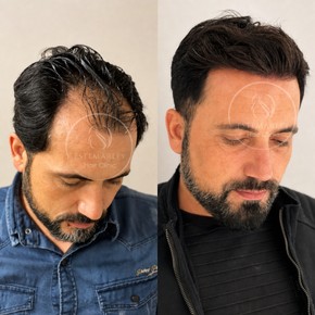 DHI Hair Transplant Premium Package - photo 4