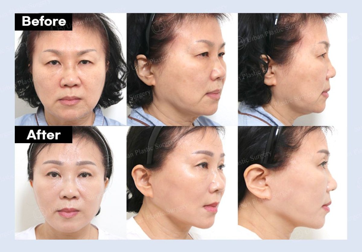 Resultados de lifting endoscópico facial antes y después en URBAN Plastic Surgery, rejuvenecimiento
